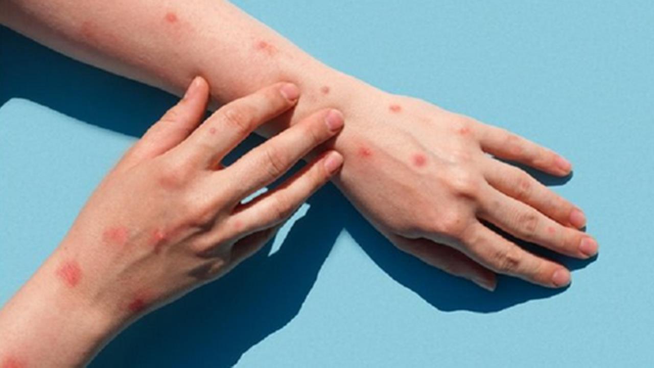 Primul caz de variola maimuţei diagnosticat în România: un bărbat de 26 de ani din Bucureşti
